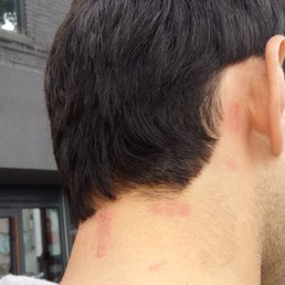 His neck after a haircut there His neck after a haircut there