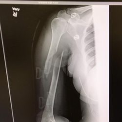 Colorado Orthopedic Consultant - Before surgery!