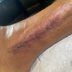 Windward Orthopaedic Group - This is 3 days after my surgery. Chefs kiss...kudos to my beautiful and the hella talented Dr. Black
