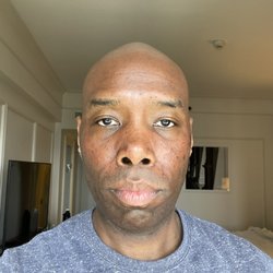 Casa Aesthetics & Spa - Few days later