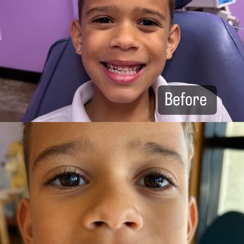 Children's Happy Teeth - Lakewood - Tooth extraction - Pediatric Dentists Near Me - Lakewood, California