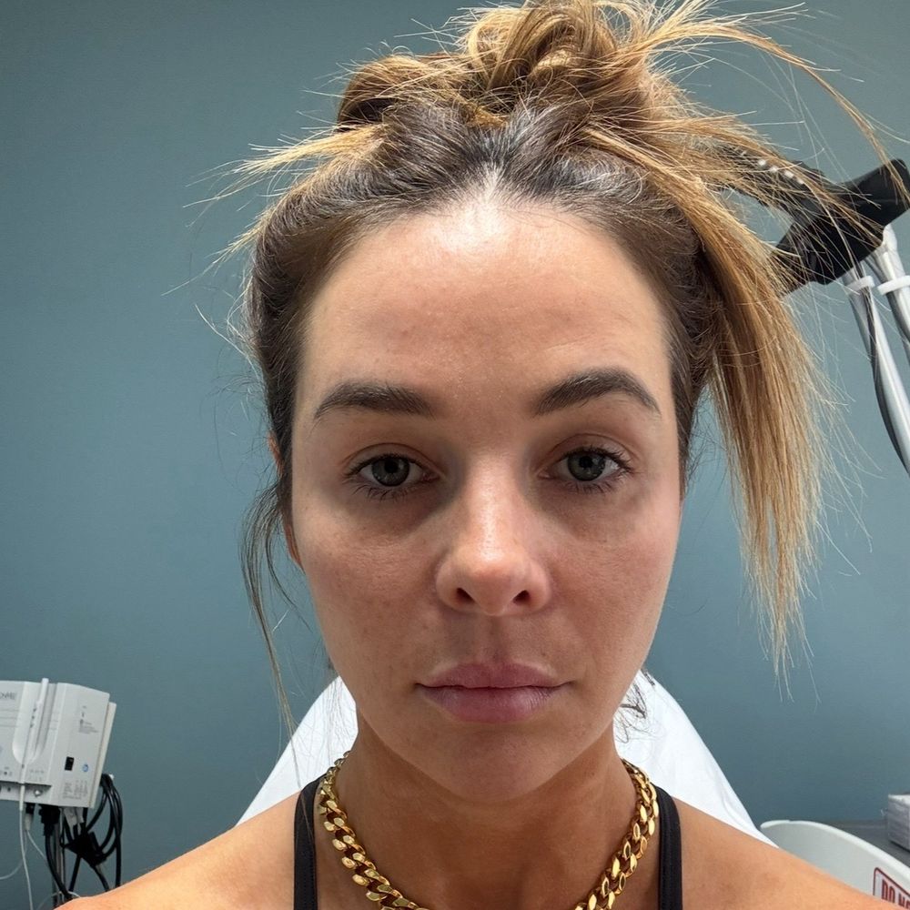 Ranch & Coast Plastic Surgery | Dr. Paul Chasan - 5 months Post op, April 2025. Uneven brows, 2 different eyebrow shapes. - Medical Spas Near Me - Del Mar, California Ranch & Coast Plastic Surgery | Dr. Paul Chasan - 5 months Post op, April 2025. Uneven brows, 2 different eyebrow shapes. - Medical Spas Near Me - Del Mar, California