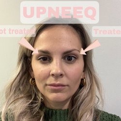 Meesha Aesthetics - Upneeq is an eye drop that opens your eyes!