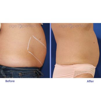 Age Perfectly - truSculpt 3D - One treatment for abdomen & flanks - Medical Spas Near Me - Wellesley, Massachusetts