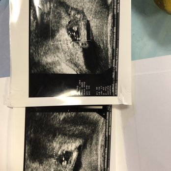 First Look Sonogram - The gender photos. - Diagnostic Imaging Near Me - Redondo Beach, California