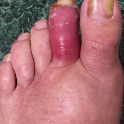 Eisenhower Infectous Disease & Infusion Center - MRSA INFECTED TOE/FOOT