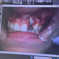 Illinois Valley Oral & Maxillofacial Surgeons - The result of the botched ramus grafting and implant on #10