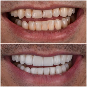 Leonid Fuks, DDS - Before/After - Cosmetic Dentists Near Me - Brooklyn, New York Leonid Fuks, DDS - Before/After - Cosmetic Dentists Near Me - Brooklyn, New York