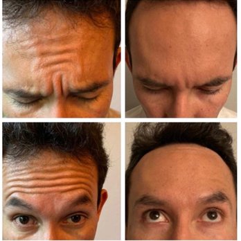 Encore MedSpa - Photos on the right are 9 days post Jeuveau treatment. The "NewTox" is most comparable to Botox, and is the latest neurotoxin on the market. - Medical Spas Near Me - Pleasanton, California Encore MedSpa - Photos on the right are 9 days post Jeuveau treatment. The "NewTox" is most comparable to Botox, and is the latest neurotoxin on the market. - Medical Spas Near Me - Pleasanton, California