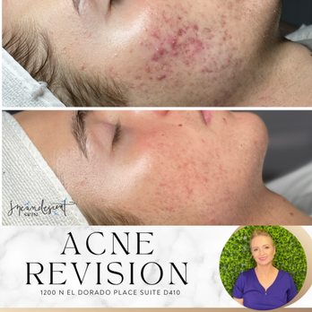 Incandescent Skin - Acne skin revision - Skin Care Near Me - Tucson, Arizona Incandescent Skin - Acne skin revision - Skin Care Near Me - Tucson, Arizona