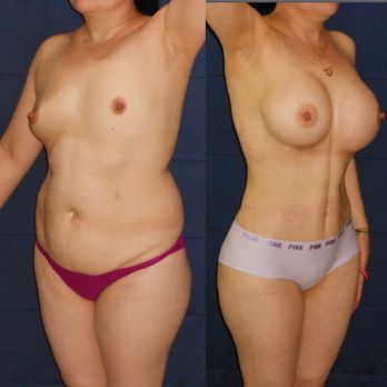 Clínica Renueva - Mommy makeover - Cosmetic Surgeons Near Me - Tijuana, BCN Clínica Renueva - Mommy makeover - Cosmetic Surgeons Near Me - Tijuana, BCN