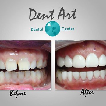 Dent Art - Porcelain Crowns/Veneers Before and After  Dent Art Center - Cosmetic Dentists Near Me - Tijuana, BCN