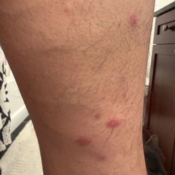 Hotel Le Bleu - Bedbug bites after 1.5 weeks - Hotels Near Me - Brooklyn, New York