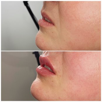 Arnprior Med Spa - Mini-lip Filler - Medical Spas Near Me - Arnprior, Ontario Arnprior Med Spa - Mini-lip Filler - Medical Spas Near Me - Arnprior, Ontario