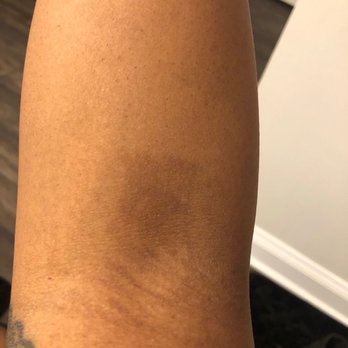 Unique Threading and Body Wax - Skin ripped - Sugaring Near Me - Atlanta, Georgia Unique Threading and Body Wax - Skin ripped - Sugaring Near Me - Atlanta, Georgia
