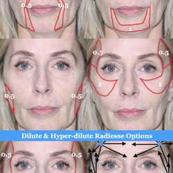 James Goodnight, MD - Everlasting Beauty - Radiesse options