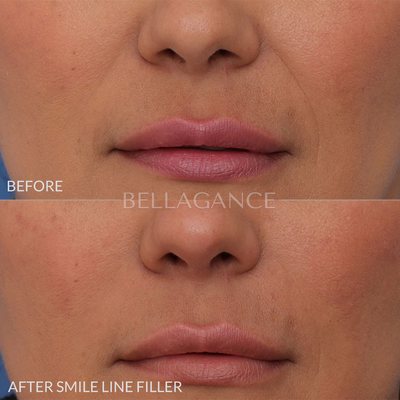 Smile line and marionette fold filler - Filler treatment performed to soften the nasolabial and marionette folds. Smile line and marionette fold filler - Filler treatment performed to soften the nasolabial and marionette folds.