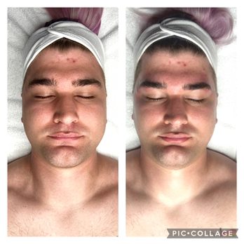 Crystal Complexion - Microdermabrasion custom facial with brow cleanup. - Hair Removal Near Me Crystal Complexion - Microdermabrasion custom facial with brow cleanup. - Hair Removal Near Me