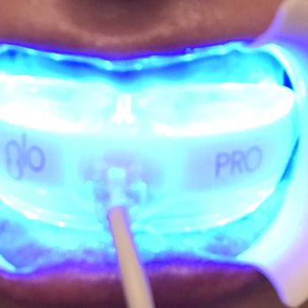 Manhasset Dental Arts - This is the GLO PRO whitening process. - Orthodontists Near Me - Manhasset, New York Manhasset Dental Arts - This is the GLO PRO whitening process. - Orthodontists Near Me - Manhasset, New York
