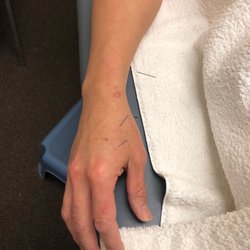 John Z Chen, MS - Barely noticeable needles.