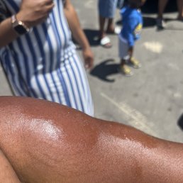 These are the bites on my arms These are the bites on my arms