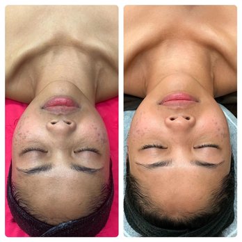 Vickkimua - Results of 3 sessions of Microdermabrasions - Skin Care Near Me - Selma, Texas Vickkimua - Results of 3 sessions of Microdermabrasions - Skin Care Near Me - Selma, Texas