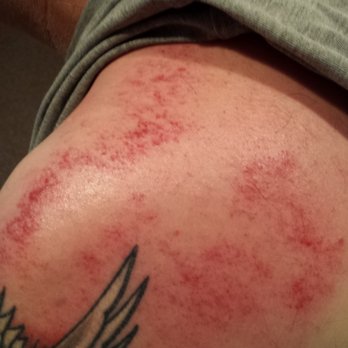 Hope with Acupuncture - Gua Sha for shoulder pain - Acupuncture Near Me - Waupaca, Wisconsin