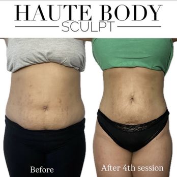 Haute Body Sculpt - Body Contouring Near Me Haute Body Sculpt - Body Contouring Near Me