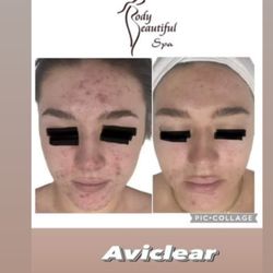 Body Beautiful Spa - Adult acne treatment