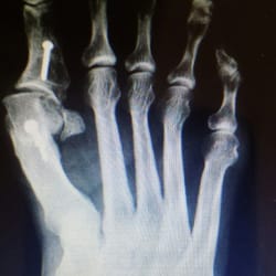 Lower Limb Institute: Mina Abadeer, DPM - Bunion