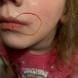Centers for Pediatric Dental Sedation - Another photo of her wound.