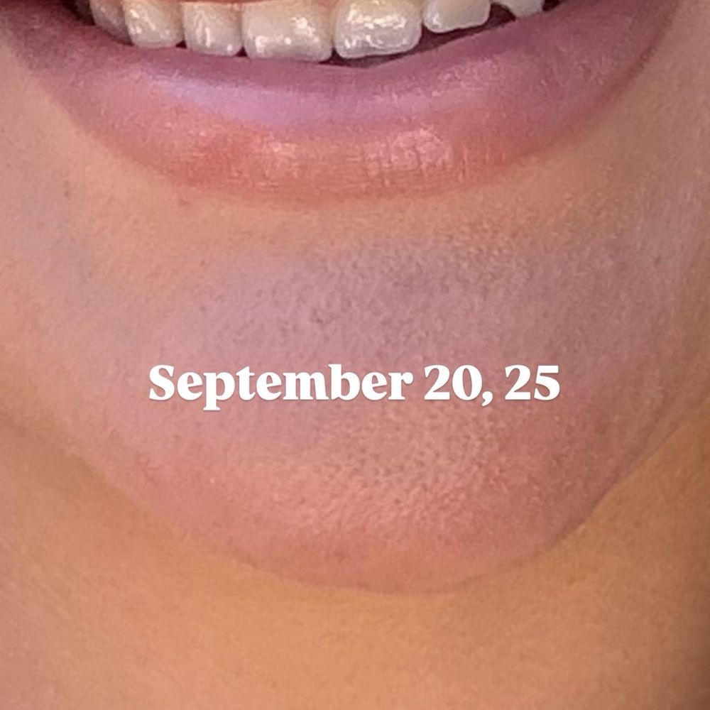 Steven K Struck, MD - After getting filler twice. It's all gone I had to over line my lips. Diluted product - Cosmetic Surgeons Near Me - Atherton, California Steven K Struck, MD - After getting filler twice. It's all gone I had to over line my lips. Diluted product - Cosmetic Surgeons Near Me - Atherton, California