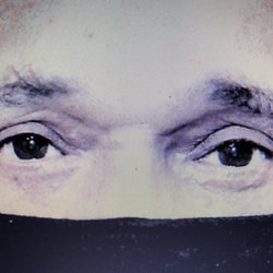 Thomas William McEwan, MD - Doctor after pic.
Left eyelid need skin graft surgery not obvious