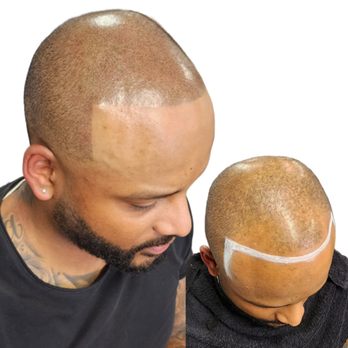 Beauty World NYC - Scalp micropigmentation - Eyelash Service Near Me - New York, New York Beauty World NYC - Scalp micropigmentation - Eyelash Service Near Me - New York, New York