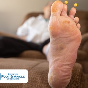 Certified Foot and Ankle Specialists - Hammertoe surgery - Podiatrists Near Me - Palm Harbor, Florida Certified Foot and Ankle Specialists - Hammertoe surgery - Podiatrists Near Me - Palm Harbor, Florida