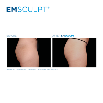Emsculpt - Emsculpt after 4th treatment - Skin Care Near Me - Beverly Hills, California