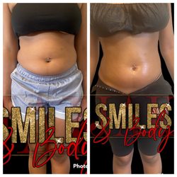 Jak Smiles - Laser lipo session