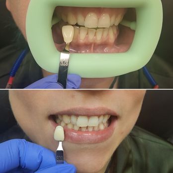 Suite Sculpt 35 - Teeth Whitening - Body Contouring Near Me - Irving, Texas Suite Sculpt 35 - Teeth Whitening - Body Contouring Near Me - Irving, Texas