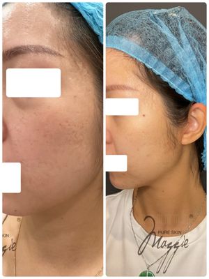 HydraFacial + RF Microneedling (Multiple Sessions) - HydraFacial + RF Microneedling (Multiple Sessions)
✨ Multiple sessions of HydraFacial and RF Microneedling helped reduce acne scars, improve skin texture, and enhance overall radiance. Notice the smoother, clearer complexion and glowing results! HydraFacial + RF Microneedling (Multiple Sessions) - HydraFacial + RF Microneedling (Multiple Sessions)
✨ Multiple sessions of HydraFacial and RF Microneedling helped reduce acne scars, improve skin texture, and enhance overall radiance. Notice the smoother, clearer complexion and glowing results!
