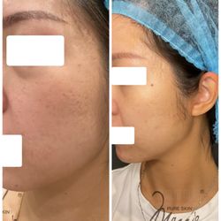 Pure Skin by Maggie - This before and after photo highlights the significant improvement in acne scars and over skin texture.
RF microneedling