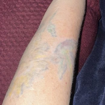 De La Ink - After 12+ laser removal sessions ‍ - Tattoo Near Me - Lone Tree, Colorado