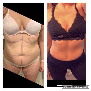 Santa Barbara Plastic Surgery Center - Tummy tuck (first procedure) - Plastic Surgeons Near Me - Santa Barbara, California Santa Barbara Plastic Surgery Center - Tummy tuck (first procedure) - Plastic Surgeons Near Me - Santa Barbara, California