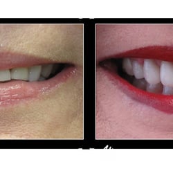 Susan A. Sheets - Before and Affer 
Full Upper Porcelain Crowns