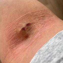St Elizabeth Imaging Center - Hematoma, some redness and irritation from bandage