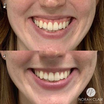 Norah Clair Aesthetics - Gummy smile treatment with Botox/Dysport! - Medical Spas Near Me - Washington, DC, District of Columbia Norah Clair Aesthetics - Gummy smile treatment with Botox/Dysport! - Medical Spas Near Me - Washington, DC, District of Columbia