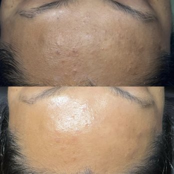 Dina Aesthetics - Acne Treatment Near Me - Dearborn Heights, Michigan Dina Aesthetics - Acne Treatment Near Me - Dearborn Heights, Michigan
