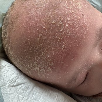 Dermspace Hawaii - Before: Craddle Cap/Baby Eczema - Hair Loss Centers Near Me - Honolulu, Hawaii Dermspace Hawaii - Before: Craddle Cap/Baby Eczema - Hair Loss Centers Near Me - Honolulu, Hawaii