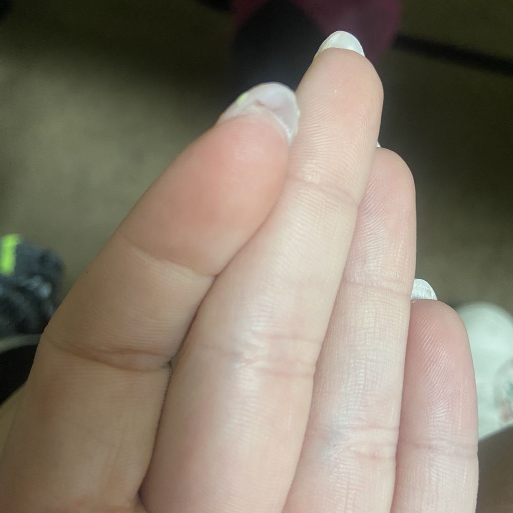 NailSHOW - Pooled acrylic left under my nail - Nail Salons Near Me - Overland Park, Kansas NailSHOW - Pooled acrylic left under my nail - Nail Salons Near Me - Overland Park, Kansas