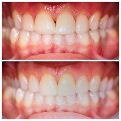 Main Street Dental Arts - Replacement old veneers