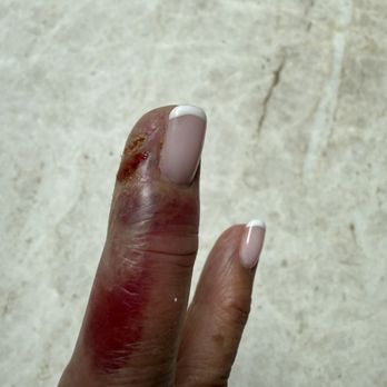 Princeton Nails - Infected finger today - Nail Salons Near Me - Princeton, New Jersey Princeton Nails - Infected finger today - Nail Salons Near Me - Princeton, New Jersey